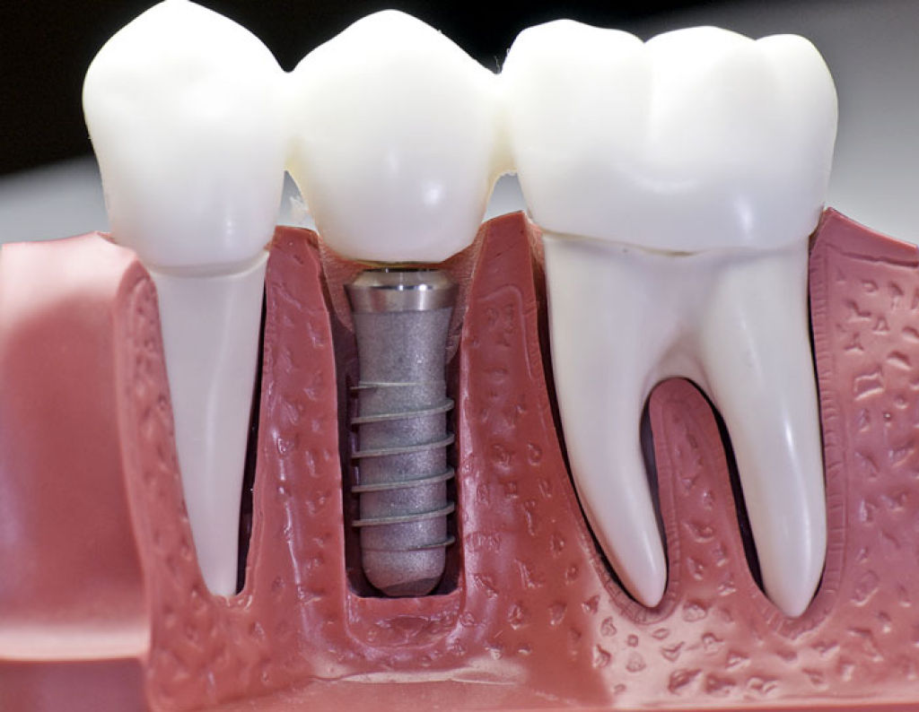 Post image of Что такое зубные имплантаты?